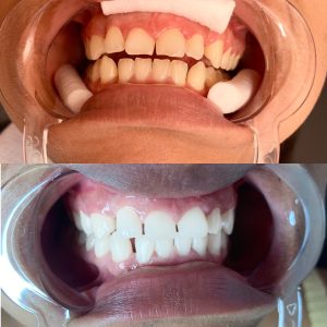Teeth Whitening ( 3 sessions)