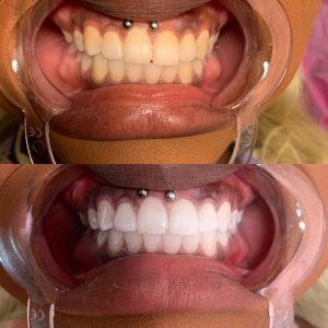 Teeth Whitening ( 2 sessions)