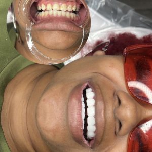 Teeth Whitening ( 1 session)