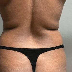 Non Surgical Fat Transfer