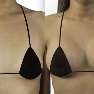 Breast Enhancement