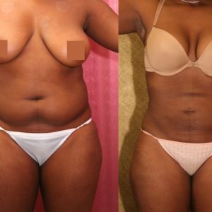 Same Day Lipo