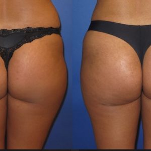 360 Lipo With Fat Transfer