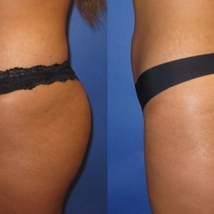 360 Lipo (Non Surgical)