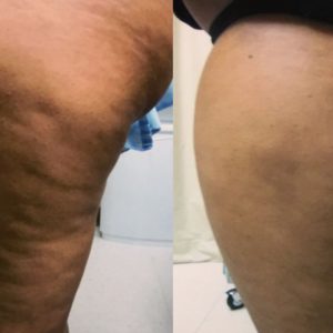 Cellulite Treatment